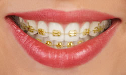 Lingual Braces in San Francisco